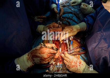 Coronary artery bypass grafting on open human heart close-up in the opened chest during the surgery Stock Photo