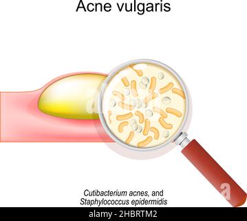 Close-up of Acne vulgaris. Cross-section of a human skin with pimple. Magnifying glass and bacteria that cause of acne. Cutibacterium acnes Stock Vector
