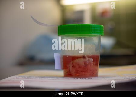 a tissue sample is placed in a formalin-filled cup after an operation Stock Photo