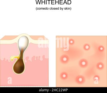 Acne. whitehead. clogged pore and comedo. Cross-section of a human skin with Hair follicle. Top view of the skin with pimples. Vector Stock Vector