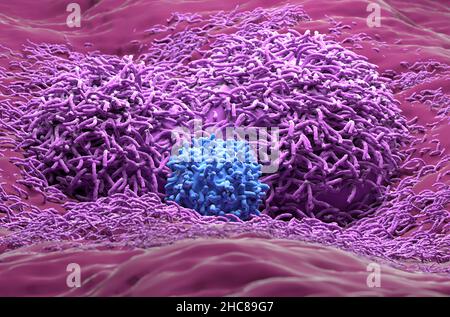 Liver cancer hepatoma realistic side closeup view 3d illustration Stock Photo