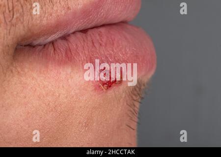 herpes in lips is a viral skin disease closeup Stock Photo