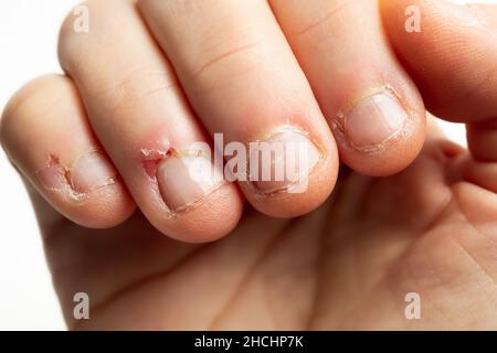 Fingers with signs of nail biting. Close up of adult female hand with chewed nails and many small wounds on the surrounding skin. Signs of mental stre Stock Photo