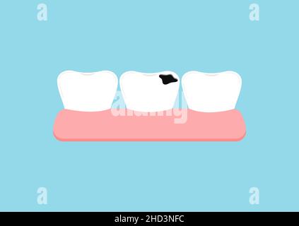 Dental caries. Healthy tooth, Tooth decay and Deep caries. Cross ...