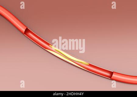 deposition, human artery, arteriosclerosis, depositions, human arteries Stock Photo