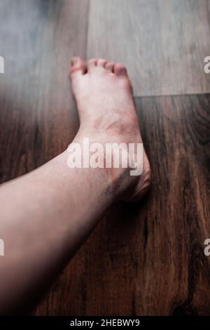 Leg of person with Raynaud's and Ehlers-Danlos syndrome with very dry, red, irritated damaged flaky skin Raynaud’s phenomenon Rare diseases Stock Photo