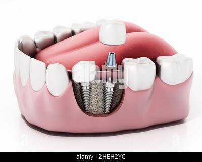 3D illustration of two dental implants on the lower jaw. Stock Photo