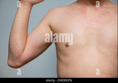 Dermatitis rash viral disease with immunodeficiency on body of young adult  asian, scratch with itch, Measles Virus, Viral Exanthem Stock Photo - Alamy