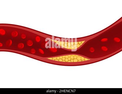 Cholesterol artery thrombosis micro vascular desease. Arteriosclerosis blood vector atherosclerosis risk Stock Vector