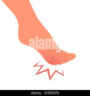 A woman leg with a sore callus. Transverse flat feet. Orthopedic disease. Foot health problems. Vector isolated illustration Stock Vector