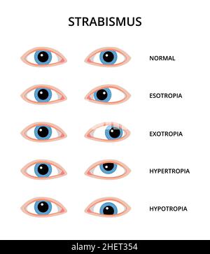 Types of strabismus. Eyes with esotropia, exotropia, hypertropia and hypotropia. Eyesight, eye examination, ophthalmology Stock Photo