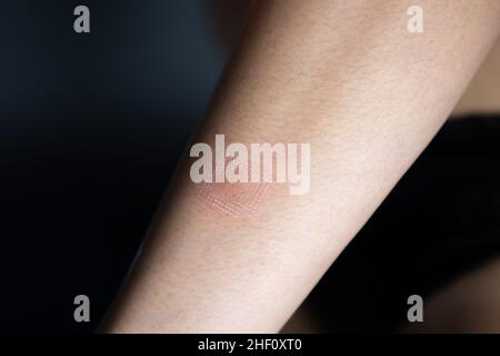 Marks after laser hair or atopic eczema scar removal from the skin. CO2 technique. Stock Photo