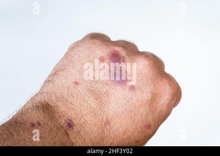 Allergic dermatitis on the skin of the hands to vaccine or medicine. Concept of health, skin care. White background. Stock Photo