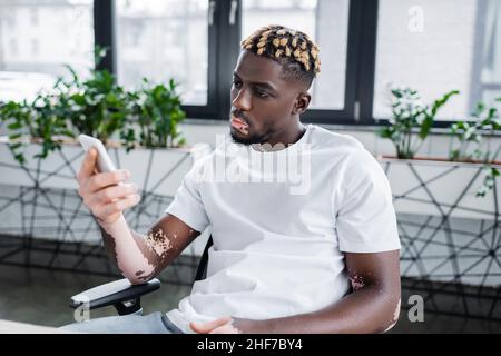 Young man with vitiligo having a cup of coffee in a cafeteria