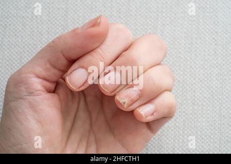 Nail fungus or nail psoriasis? : r/NailFungus