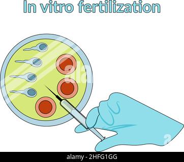 In vitro fertilization. Detailed infographic showing laboratory fertilization of eggs. Stock Vector