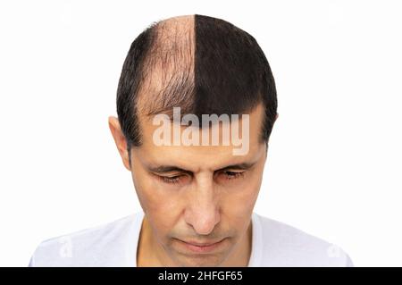 Man before and after hair loss treatment on white background Stock Photo
