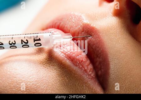 Lip shape correction procedure in a cosmetology salon. The specialist makes an injection on the lips of the patient. Lip augmentation. Stock Photo