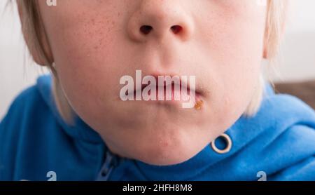 Göteborg, Sweden - April 06 2017: Impetigo around the mouth of a child.. Stock Photo
