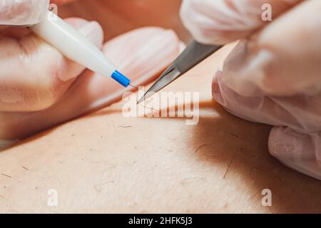 The process of permanent hair removal, removing unwanted hair using an electroepilation device and tweezers, close-up macro photography. Stock Photo