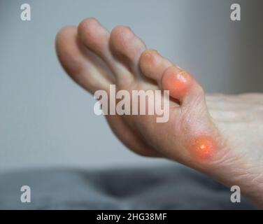 Plantar wart on the foot and little toe in humans. Treatment and removal of warts on the sole in dermatology. Stock Photo