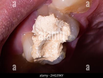 Installation of a temporary filling in the treatment of tooth canals, endodontics. Tooth pulpitis in dentistry Stock Photo
