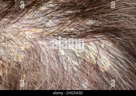 Cropped short of a woman's dandruff in the hair and scalp Stock Photo