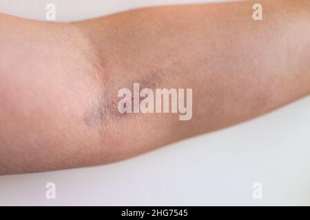 Macro closeup of female woman arms with large bruise medical condition due to blood test or vaccine showing texture of skin and blood Stock Photo