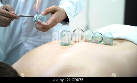 Acupuncture therapist placing a cup on the back of a male patient, ancient Chinese alternative medicine. Close up for a doctor giving cupping treatmen Stock Photo