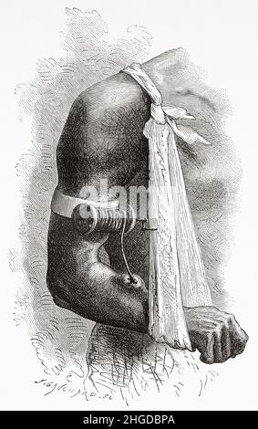 Guinea worm disease. Dracunculiasis. A disease caused by nematode roundworm Dracunculus medinensis, it occurs by drinking unfiltered water containing copepods infected with larvae. Old 19th century engraved illustration from Four months in Florida by Achille Poussielgue, Le Tour du Monde 1870 Stock Photo