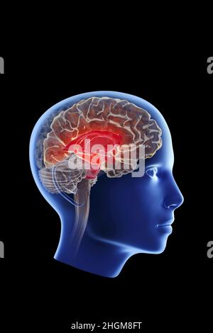 Alzheimer's disease. Illustration of amyloid plaques amongst neurons ...