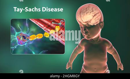 Tay-Sachs disease, computer illustration Stock Photo
