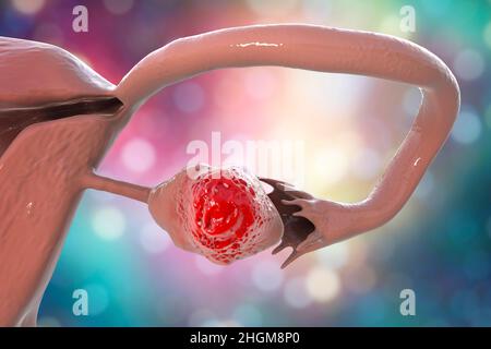 Ovarian cancer, illustration Stock Photo