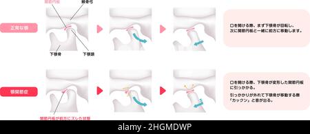 Comparison illustration of normal jaw and Temporomandibular disorders ...
