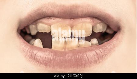 Bad teeth child. Portrait boy with bad teeth. Child smile and show her crowding tooth. Close up of unhealthy baby teeths. Kid patient open mouth Stock Photo