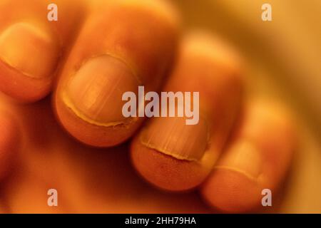 Bitten fingernails of a man Stock Photo