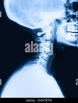 CERVICAL OSTEOARTHRITIS, MRI Stock Photo - Alamy