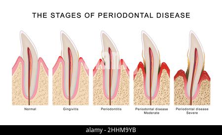 The stages of periodontal disease Stock Photo