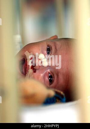 BABY VASILE BUCATARU FROM ROMANIAN ORPHANAGE IN RECOVERY ROOM  AFTER CORRECTIVE SURGERY BY UK SURGEON OLIVER FENTON TO REPAIR HIS CLEFT LIP. BRASOV HOSPITAL. ROMANIA.      Picture: GARYROBERTSPHOTOGRAPHY.COM Stock Photo