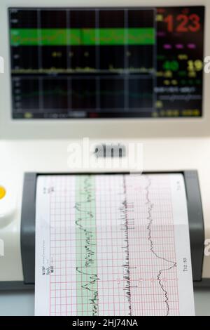 Cardiotocogramme Electronic Cardiotocography Machine Monitoring Fetal Heart Contractions ...