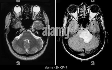 MRI of normal brain (left) and one with acute multiple sclerosis (right). On the left is an MRI scan, T2 weighted, axial view through the brain of a 54 year old female. On the right is an axial MRI image of the brain through the level of the brain stem, revealing extensive edema and enlargement of the pons extending into the left (on your right) middle cerebellar peduncle. There is prominent ring enhancement on post contrast images. This represents a form of acute MS that can stimulate a tumor; therefore, it is referred to as tumefactive. Stock Photo