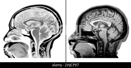 MRI (sagittal view) of normal brain (left) and one showing a colloid cyst of the third ventricle (right). A colloid cyst is a cyst containing gelatinous material in the brain. Because of its location, it can cause obstructive hydrocephalus and increased intracranial pressure. These cysts account for approximately 1% of all intracranial tumors and can cause headache, vertigo, memory deficits, diplopia, behavioral disturbances and in extreme cases, sudden death. Stock Photo