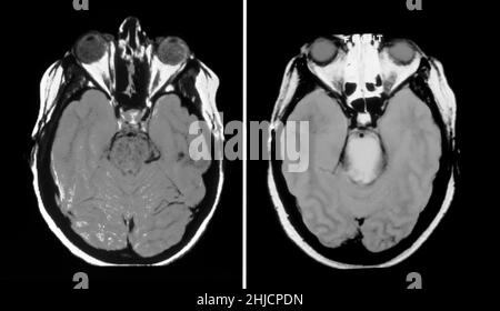 On the left is an MRI scan (axial view) through the normal brain of a 31-year-old female. On the right is an axial MRI of the brain in a person with multiple cranial nerve deficits, showing enlargement of the brainstem at the level of the pons with abnormal increased signal intensity (whiter). This represents a primary neoplasm of the brainstem called a glioma, a cancerous tumor. Stock Photo