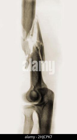 An x-ray of fractured bone. Date: circa World War I. Stock Photo