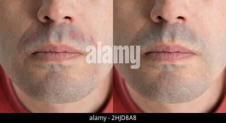 Photo with and without dermatitis. Concept of irritated skin in men after shaving. Photos before and after treatment Stock Photo