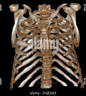 Extramedullary haematopoiesis, 3D CT scan Stock Photo