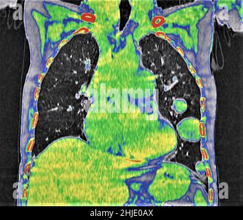 Cannonball pulmonary metastases, CT scan Stock Photo