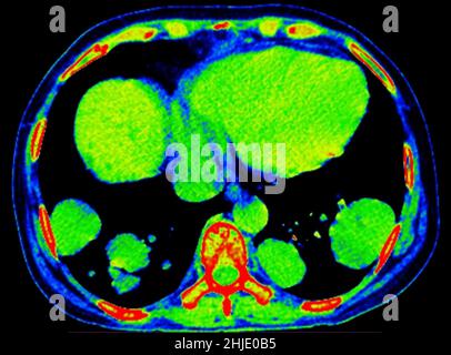 Cannonball pulmonary metastases, CT scan Stock Photo