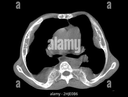 Extramedullary haematopoiesis, CT scan Stock Photo