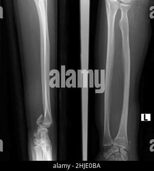 smith fracture